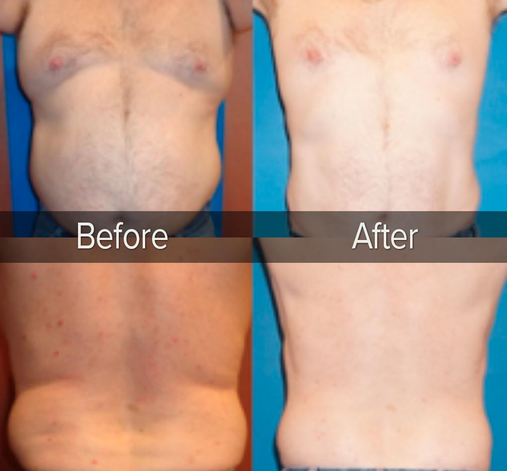 Post Weight Loss Skin Tightening - New You Bariatric Center
